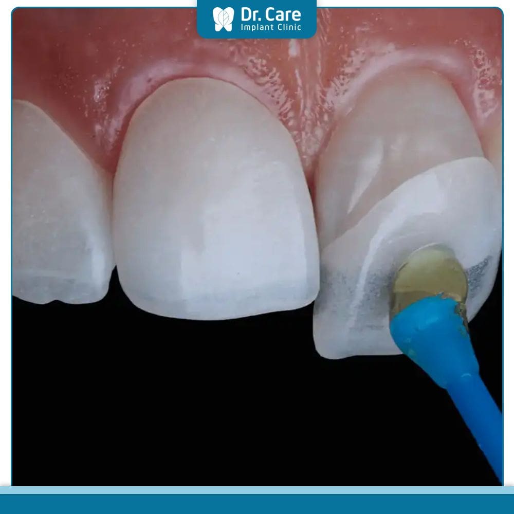 Chính sách bảo hành của răng sứ veneer Emax