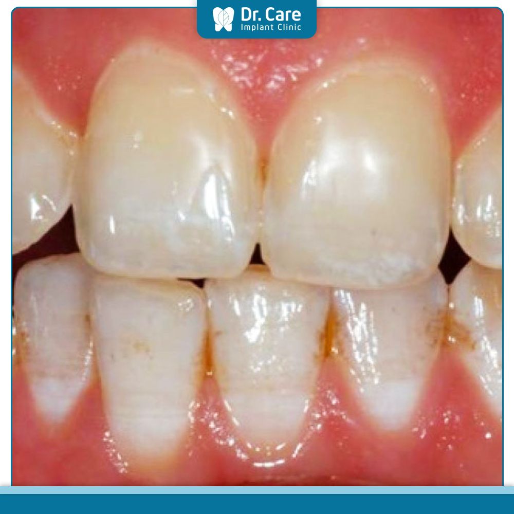 Răng nhiễm fluor là gì?
