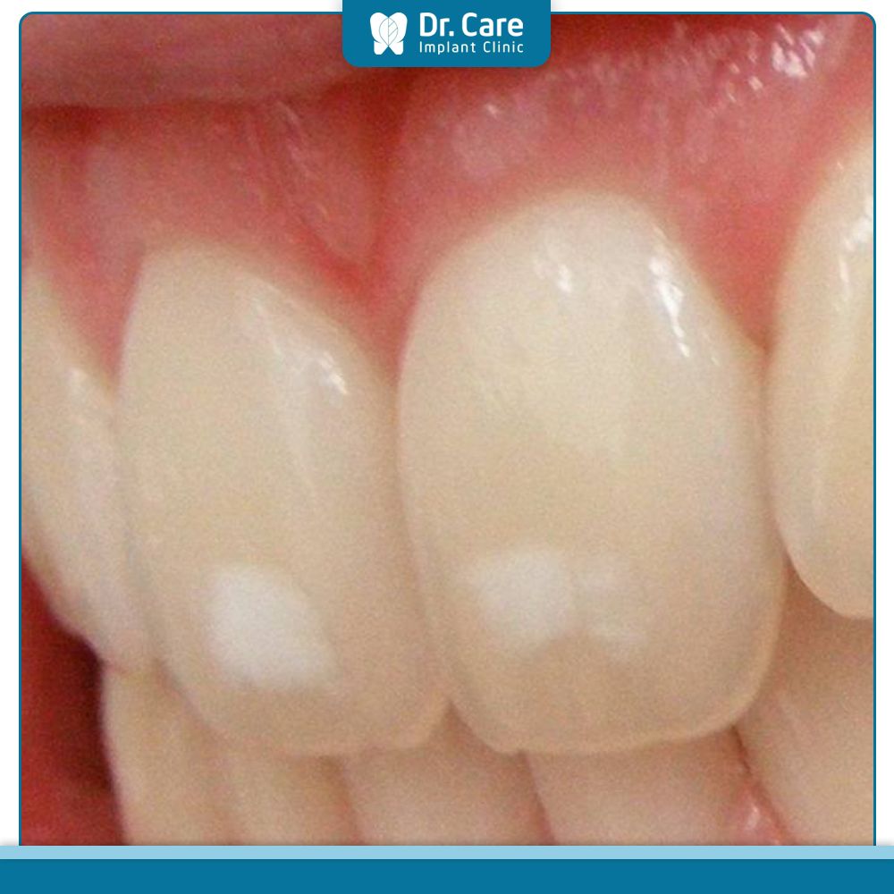 Dấu hiệu răng nhiễm fluor