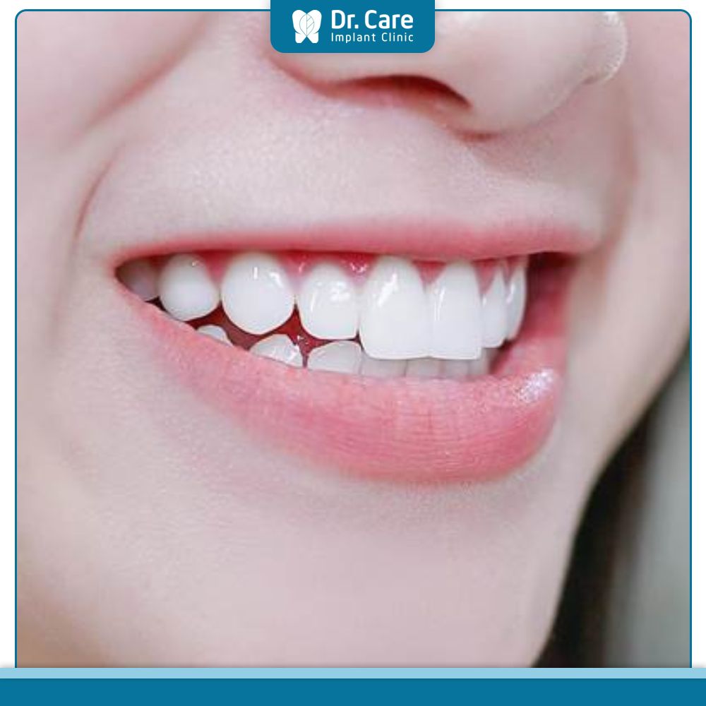 Nên chọn loại răng sứ nào cho vị trí răng cửa?