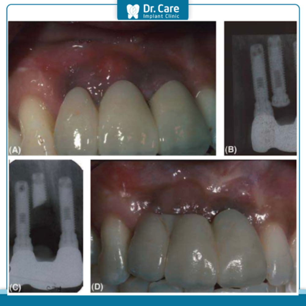 Vấn đề về mô mềm cần phải lưu ý trước khi thực hiện trồng răng Implant
