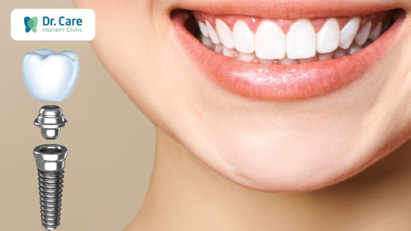 Những lưu ý khi mất răng hàm số 6 và cấy ghép Implant (trồng răng Implant)