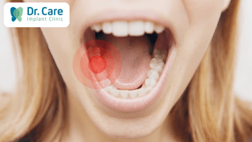 Sâu răng sau khi bọc răng sứ có thể xảy ra không?
