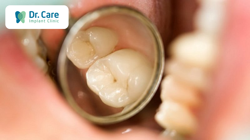Một số cách phát hiện sâu răng dễ thấy nhất