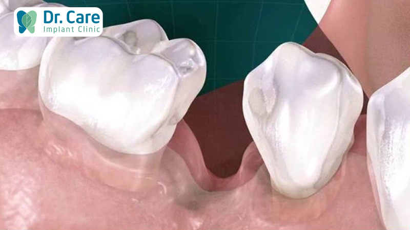 Những dạng tiêu xương hàm thường gặp sau khi mất răng