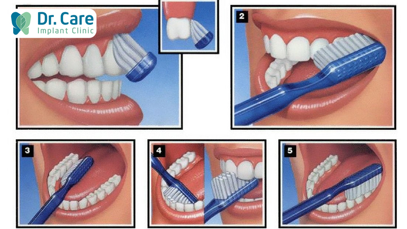 Cách vệ sinh răng sứ theo lời khuyên của Nha sĩ