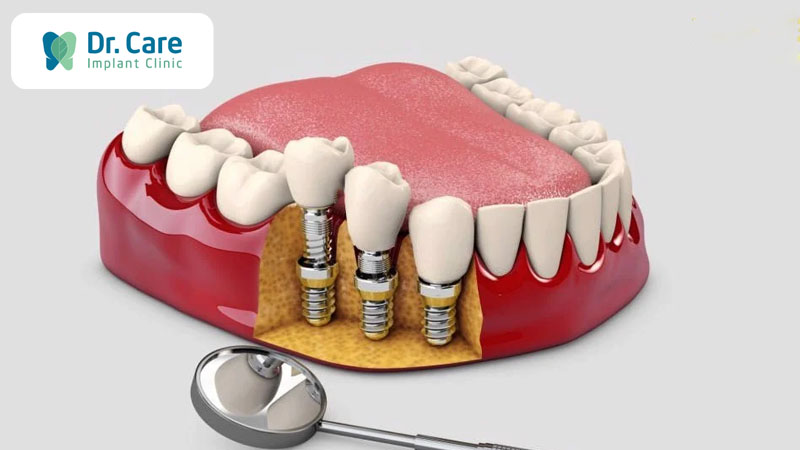Trồng răng Implant là gì? Ưu điểm vượt trội của răng Implant