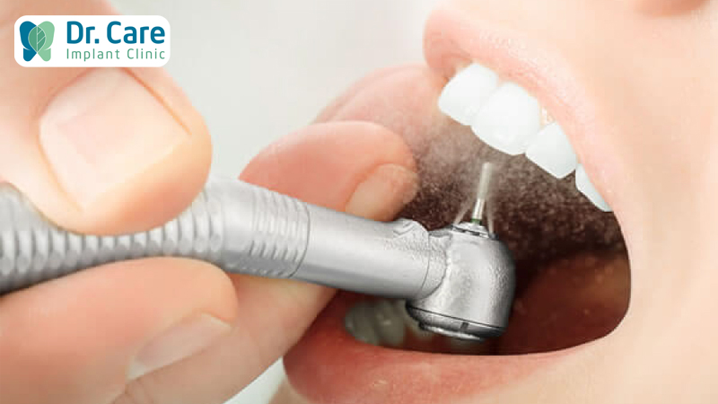 Quy trình bọc răng sứ Zirconia tại Nha khoa uy tín