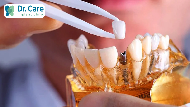 Trồng răng Implant nên chọn răng sứ Zirconia hay răng sứ Titan?