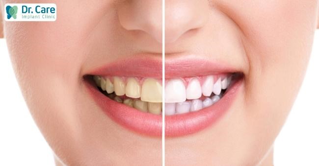 Răng bị ngả vàng trước và sau khi bọc răng sứ