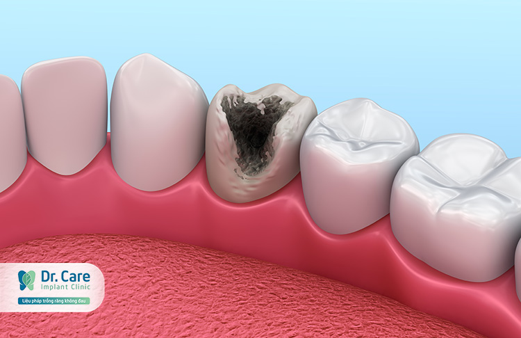 Như thế nào là răng sâu bị vỡ, mất răng nhưng còn lại chân răng?