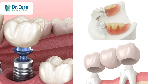 Phục hình răng là gì? Có bao nhiêu phương pháp phục hình răng?