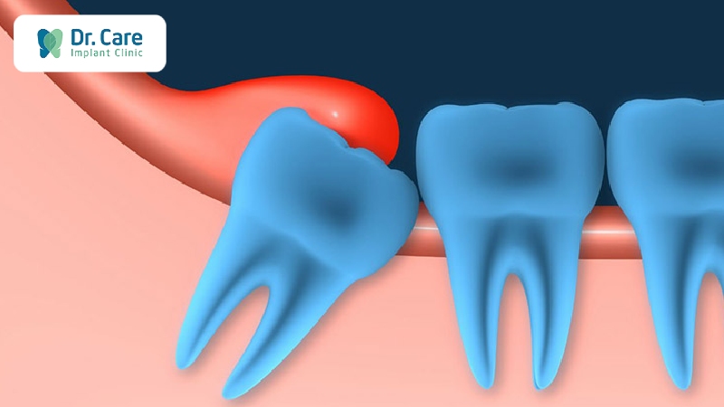 Nguyên nhân gây sưng nướu chân răng có mủ