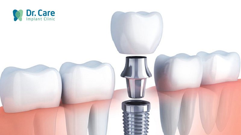 Trồng răng Implant là gì? Ưu - nhược điểm