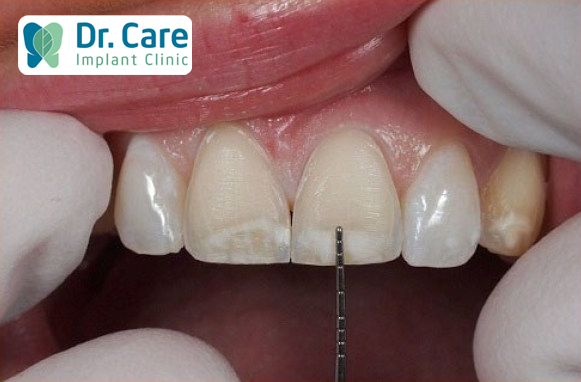 Mài răng bọc sứ có ảnh hưởng gì không?