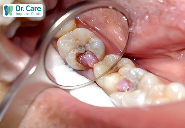 Một số biến chứng khi bọc răng sứ không đảm bảo chất lượng