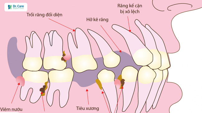 Khi răng bị mất và không được phục hồi, các răng còn lại sẽ bị ảnh hưởng theo. Đối với người bình thường, răng đầy đủ, mỗi răng sẽ nâng đỡ cho nhau, lực nhai được trải đều ra.