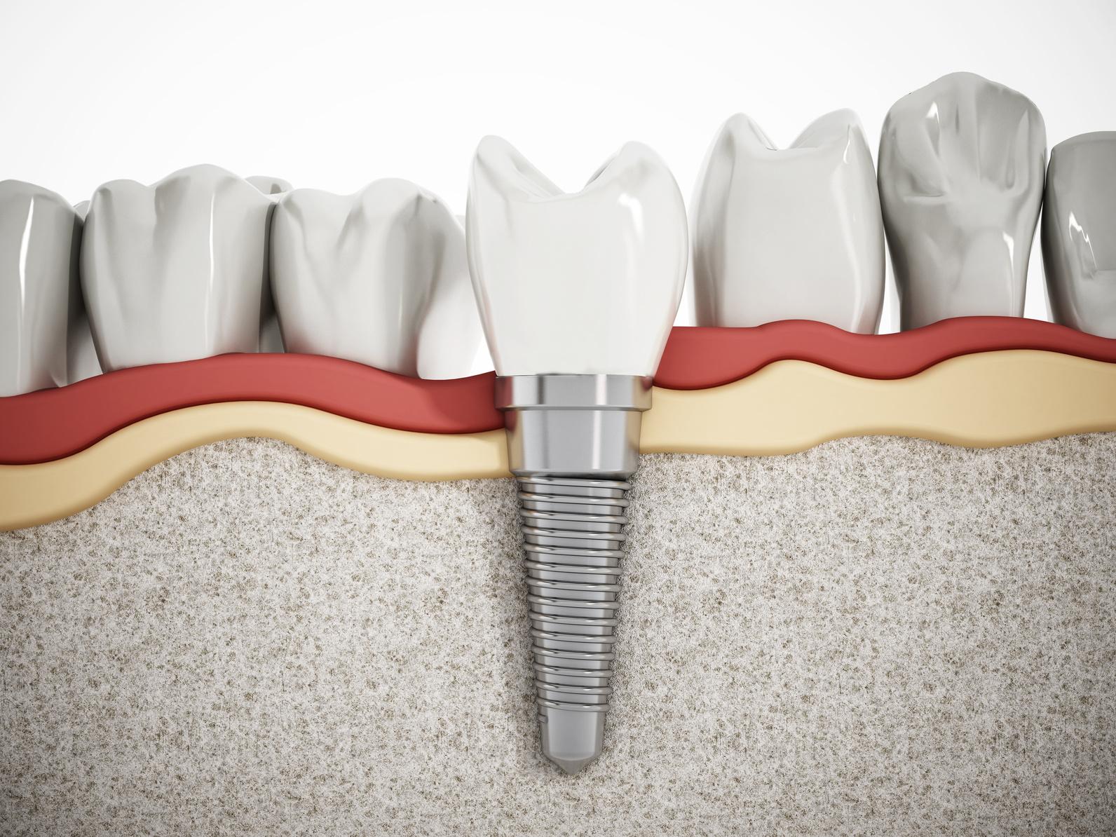 Răng Implant thay thế 1 răng hỗ trợ ăn nhai vượt trội hơn so với cầu răng sứ hoặc răng tháo lắp
