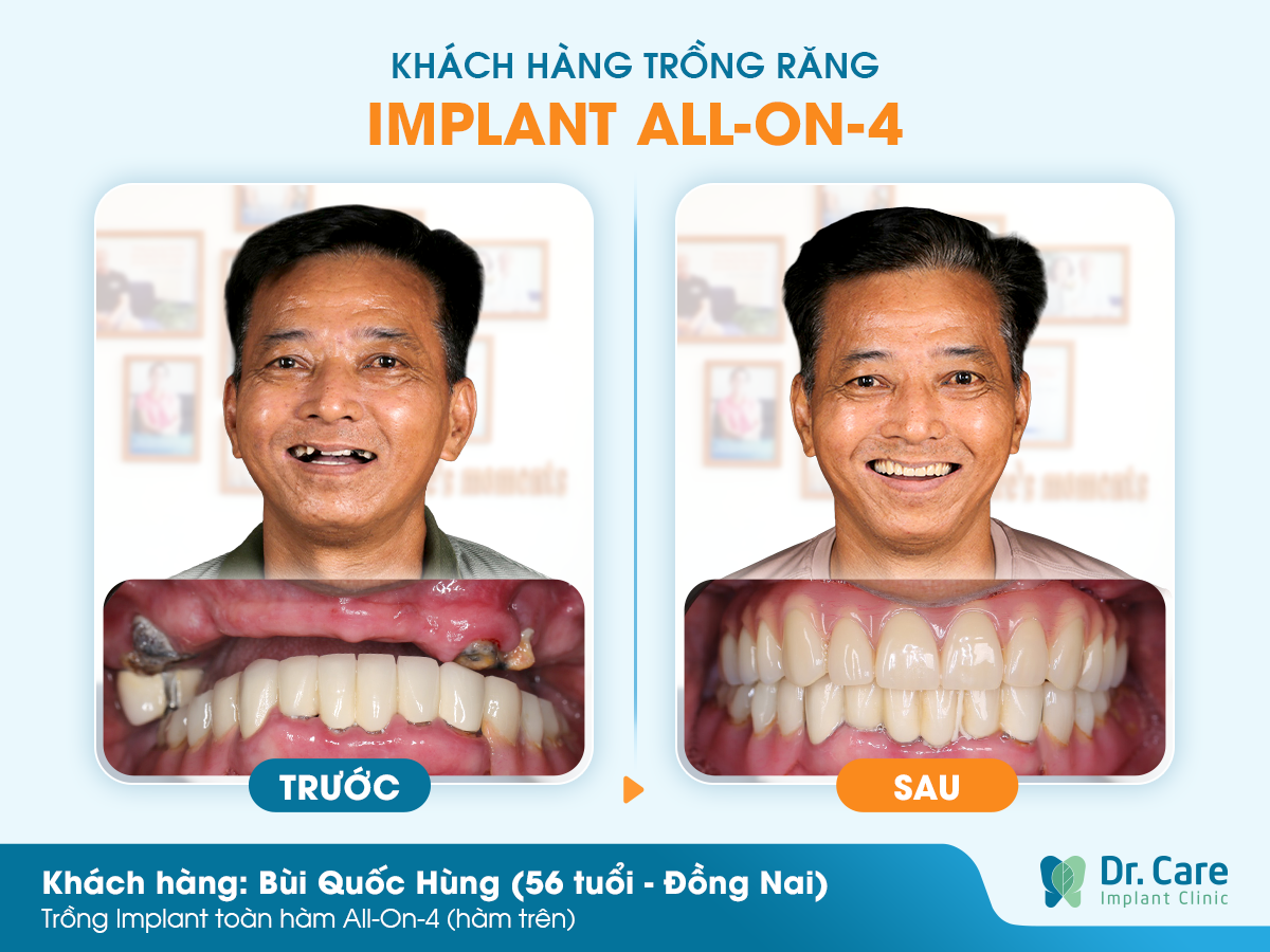 Cảm nhận khách hàng sau khi trồng răng Implant tại Dr. Care