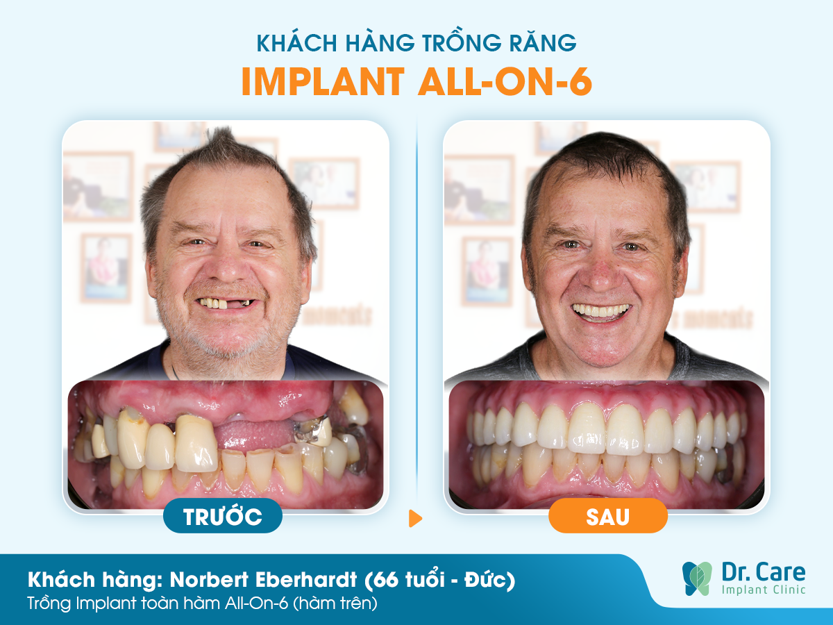 Cảm nhận khách hàng sau khi trồng răng Implant tại Dr. Care