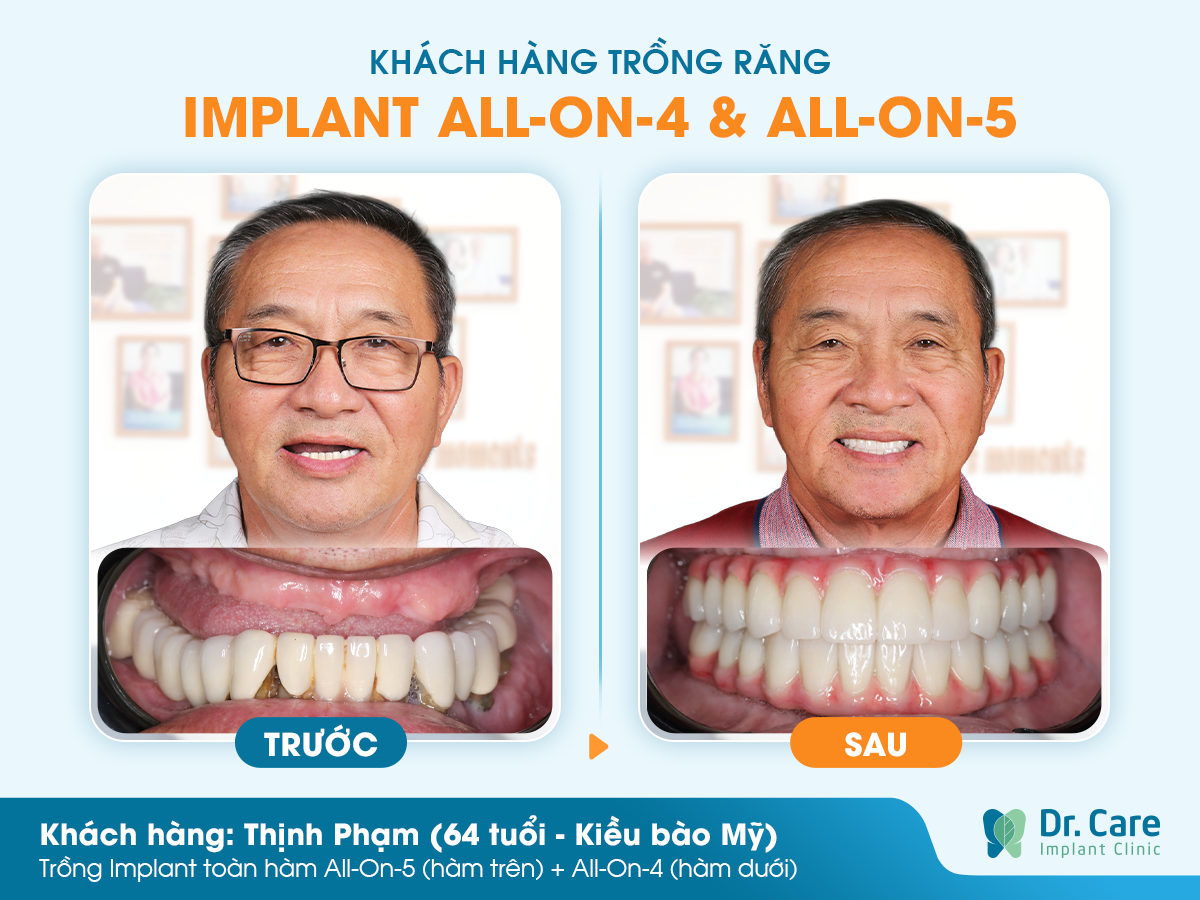 Cảm nhận khách hàng sau khi trồng răng Implant tại Dr. Care