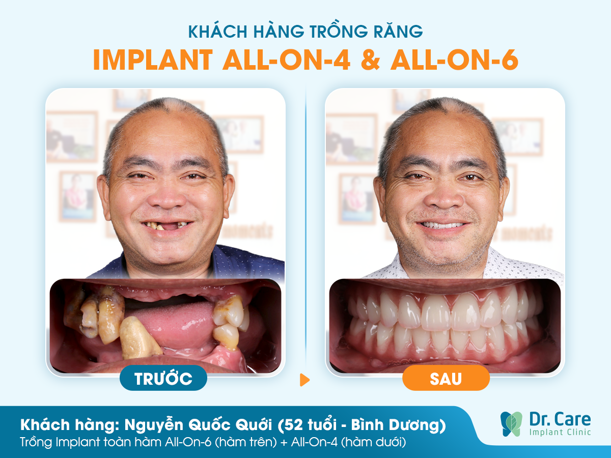 Cảm nhận khách hàng sau khi trồng răng Implant tại Dr. Care