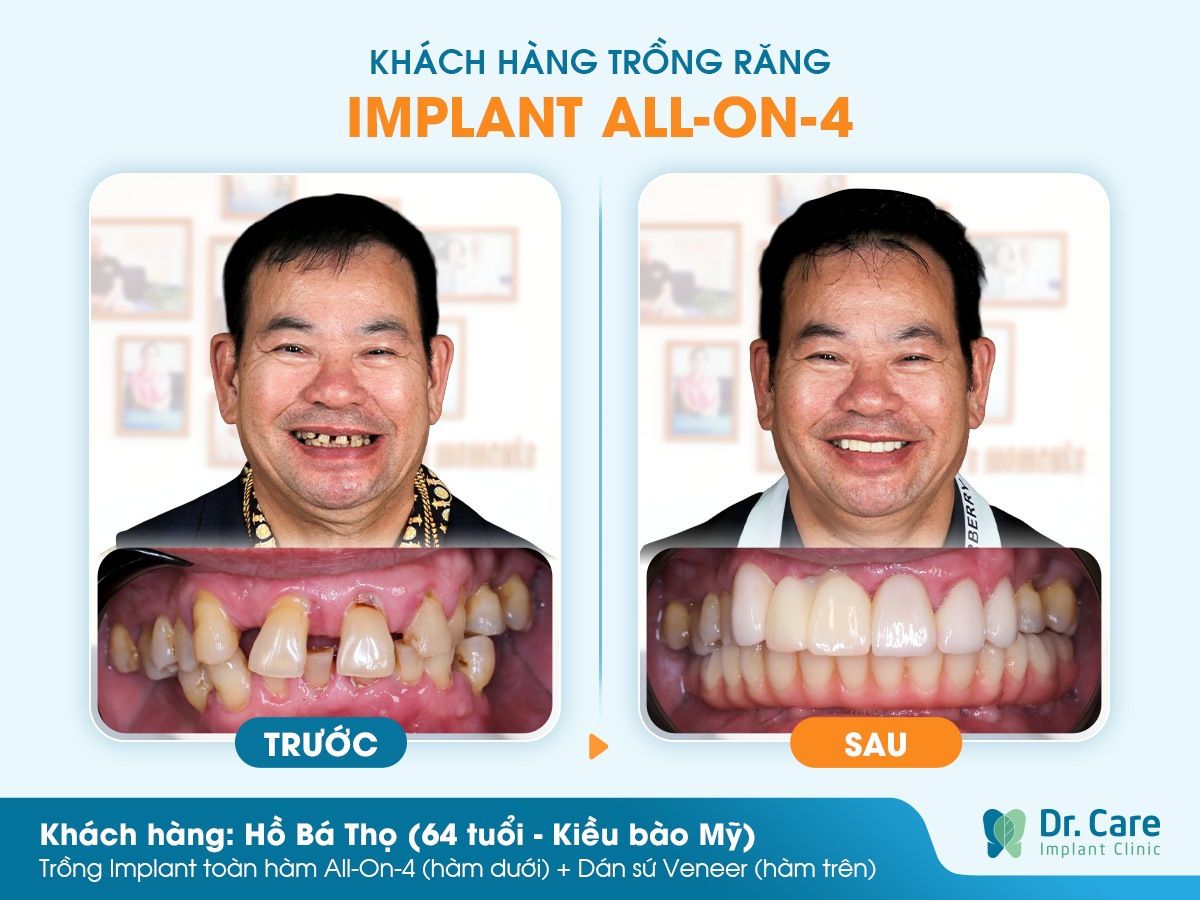 Cảm nhận khách hàng sau khi trồng răng Implant tại Dr. Care