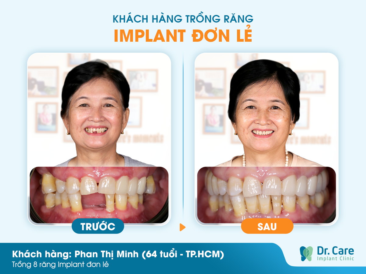 Cảm nhận khách hàng sau khi trồng răng Implant tại Dr. Care