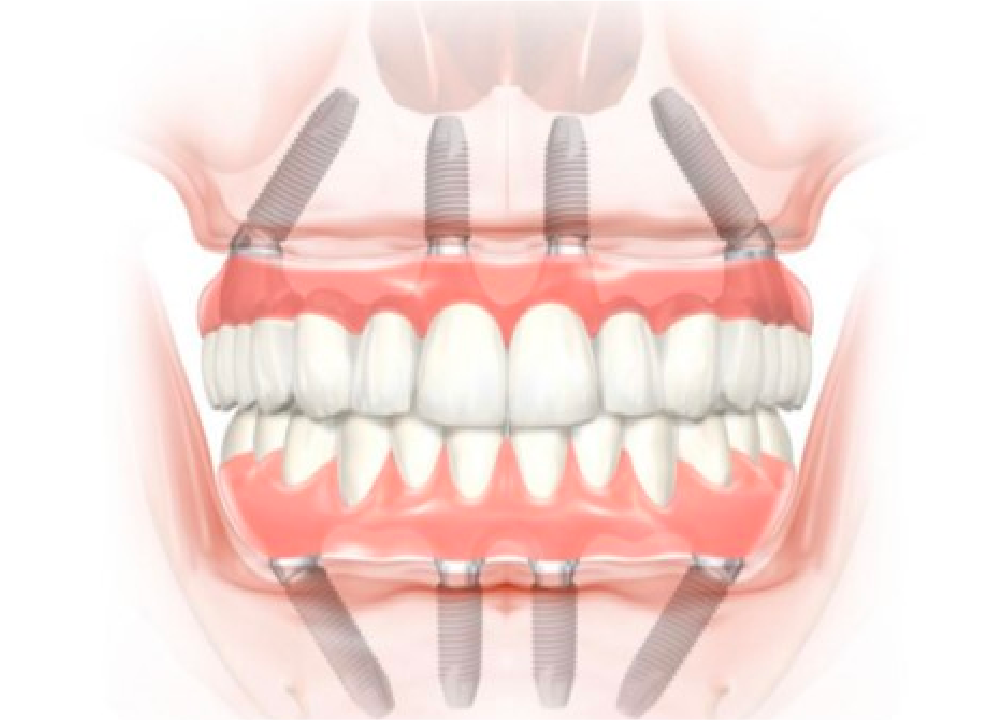 Trồng răng toàn hàm