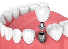 Trồng răng implant thay thế 1 răng