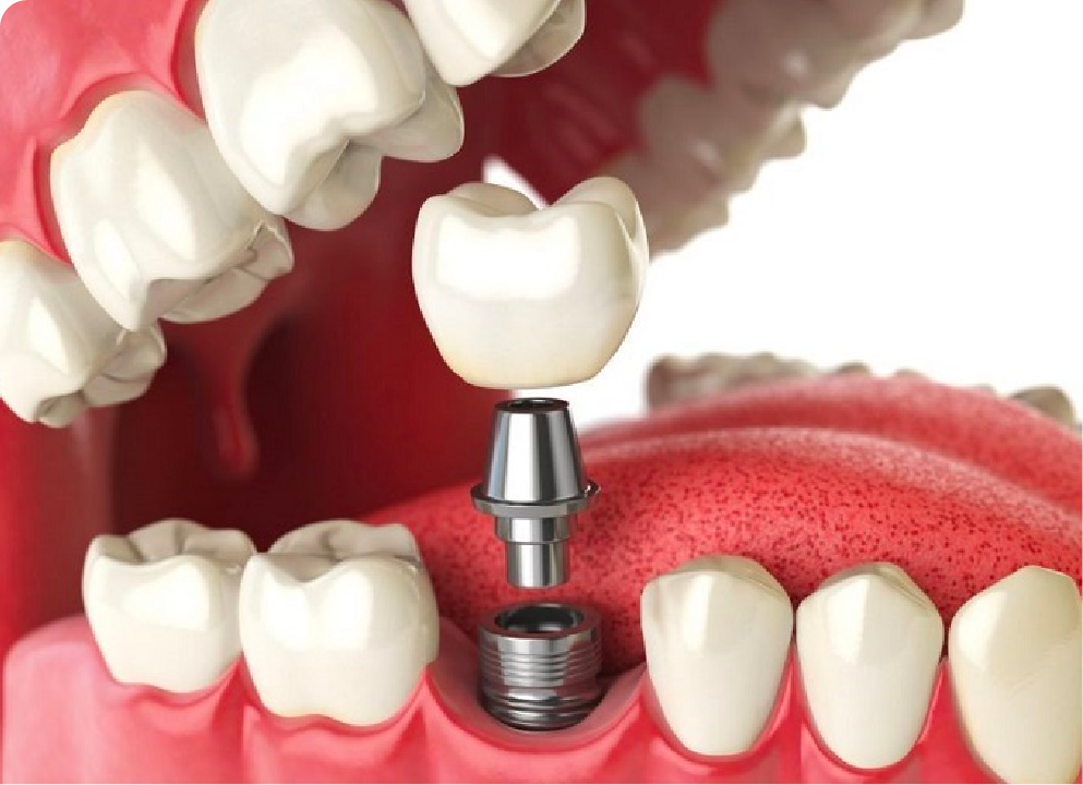 Trồng răng implant thay thế 1 răng