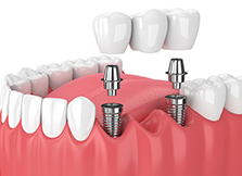 Trồng răng implant thay thế 1 vài răng
