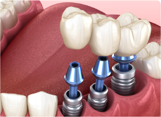 Trồng răng implant thay thế 1 vài răng