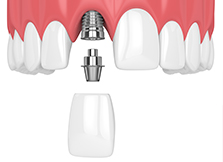 Trồng răng implant và phục hình tức thì