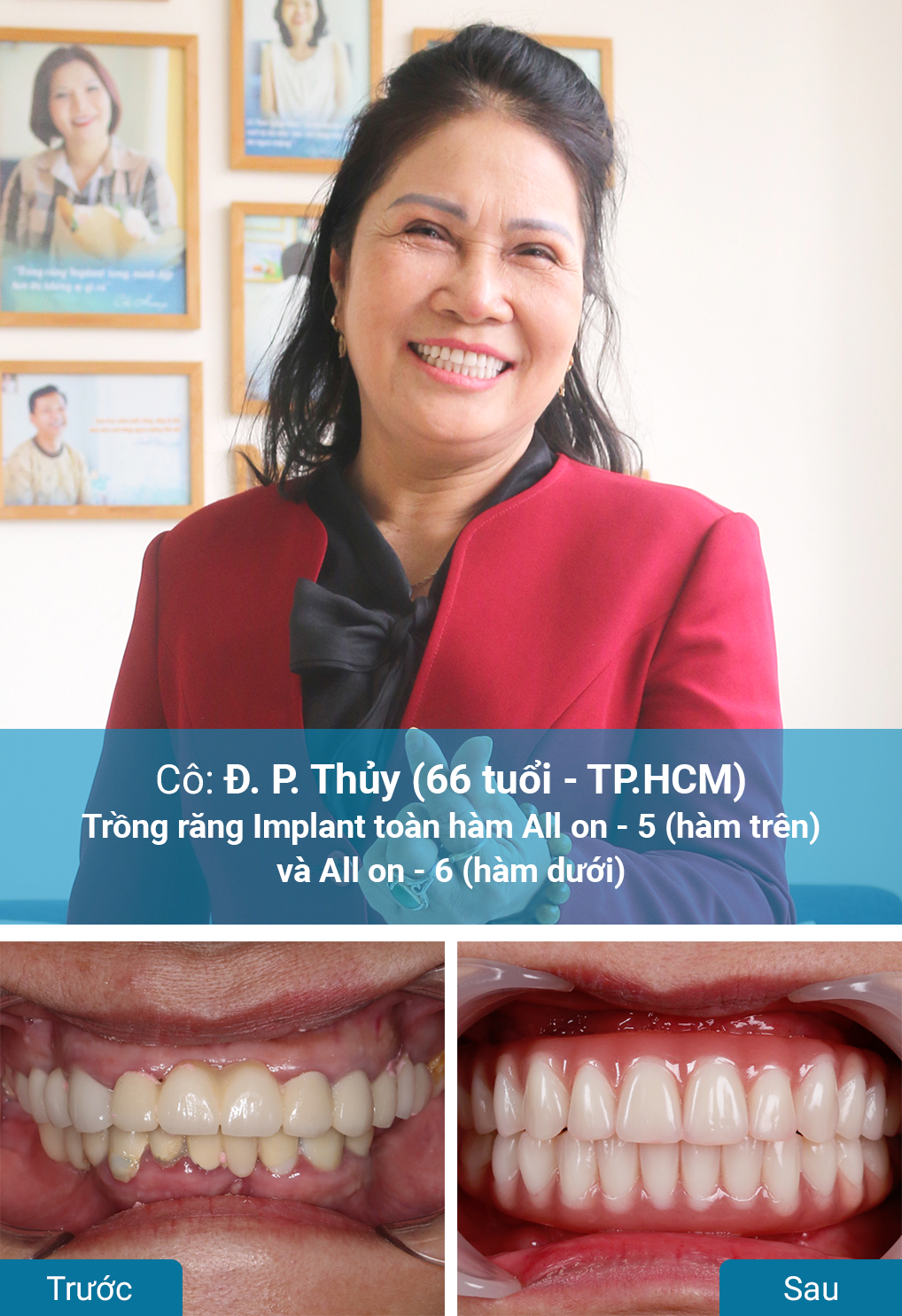 Khách hàng trồng răng Implant tại nha khoa Dr. Care