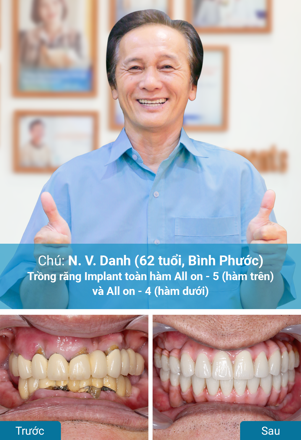Khách hàng trồng răng Implant tại nha khoa Dr. Care