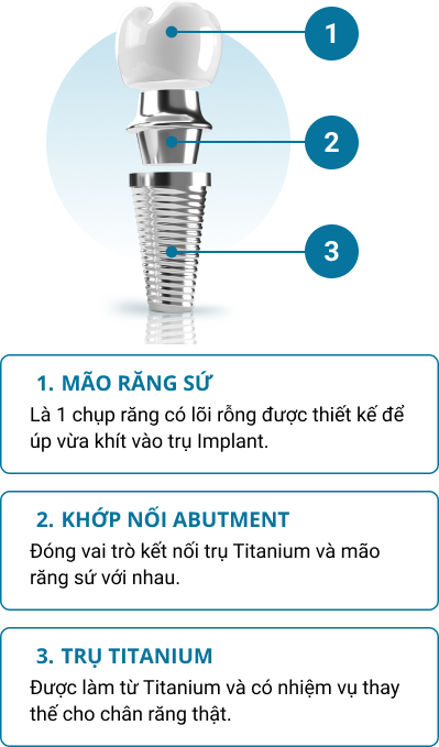 Cấu tạo của trụ Implant