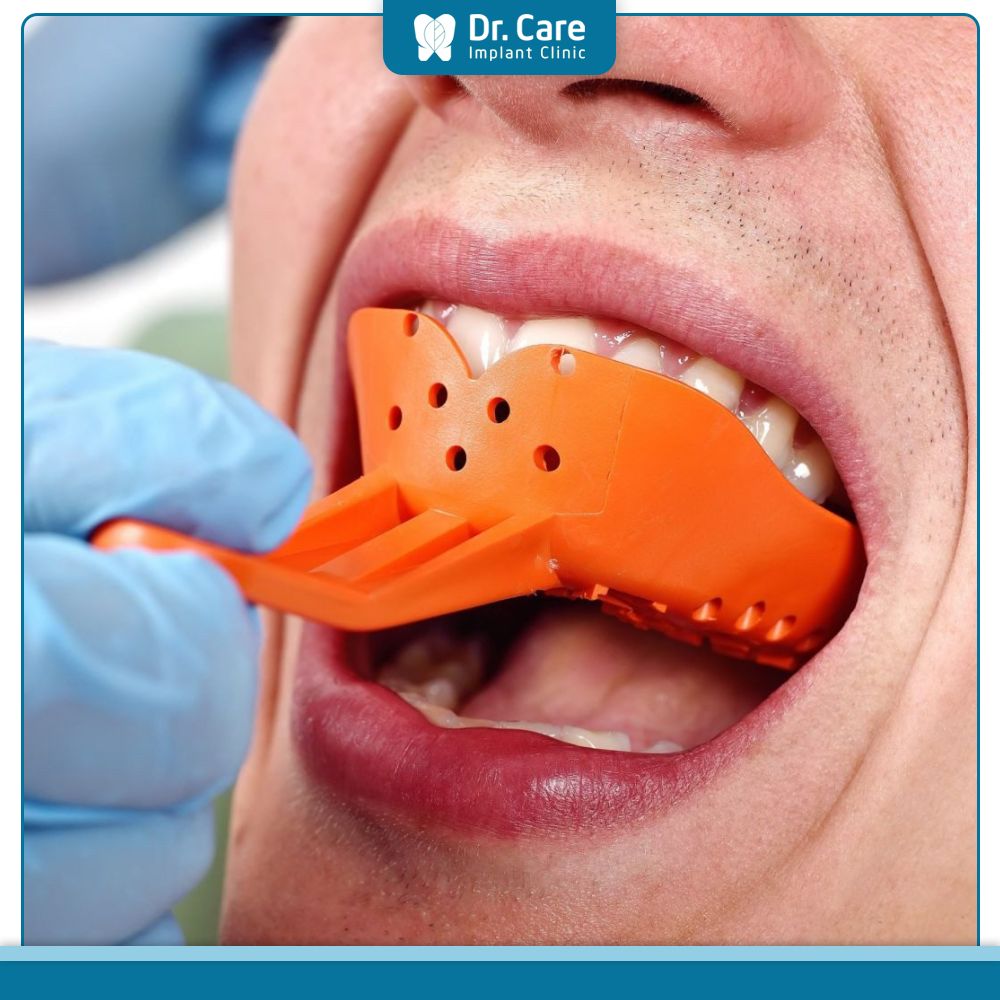 Quy trình bọc răng sứ nguyên hàm