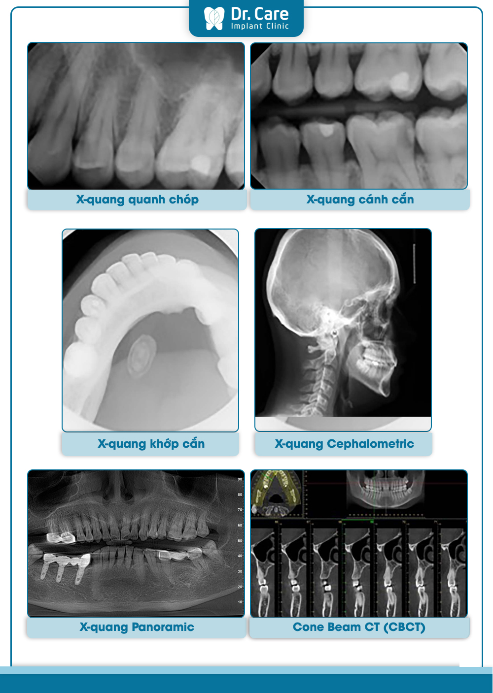 Chụp X quang răng có những loại nào?
