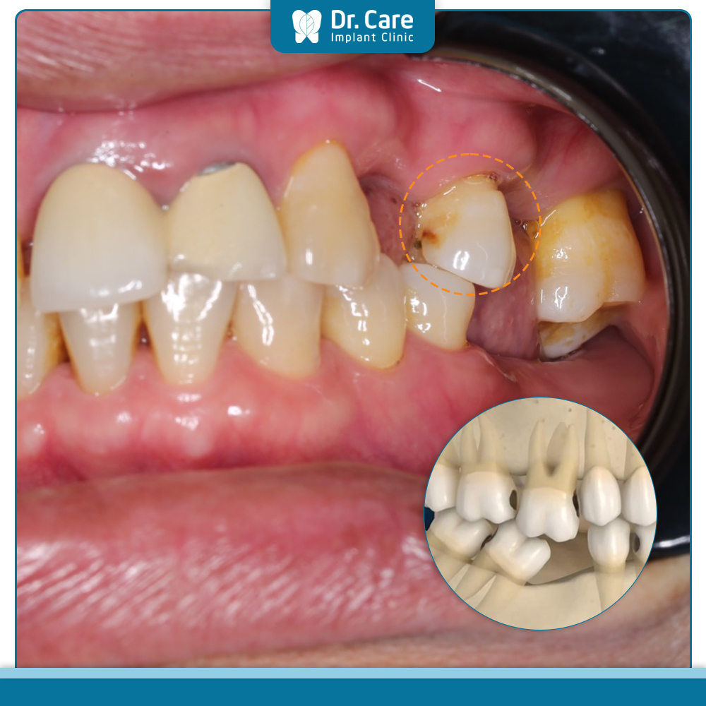 Nguyên nhân gây ra tình trạng mất răng ở người lớn tuổi