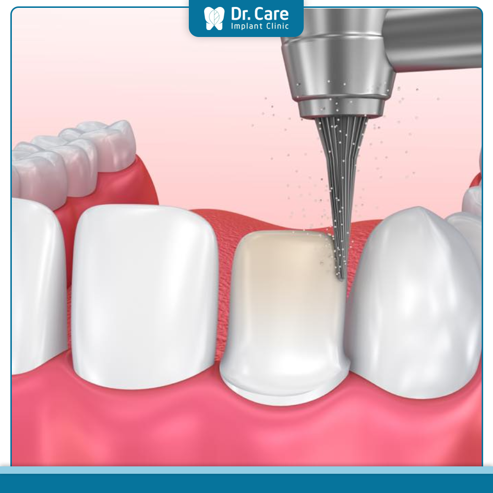 Nguyên nhân răng bị đau sau bọc răng sứ 