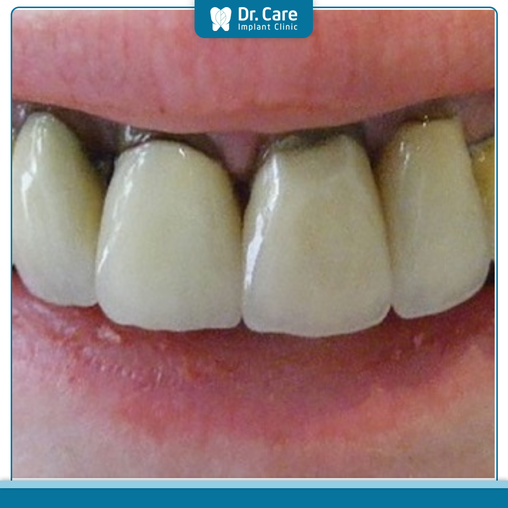 Nguyên nhân răng bị đau sau bọc răng sứ 