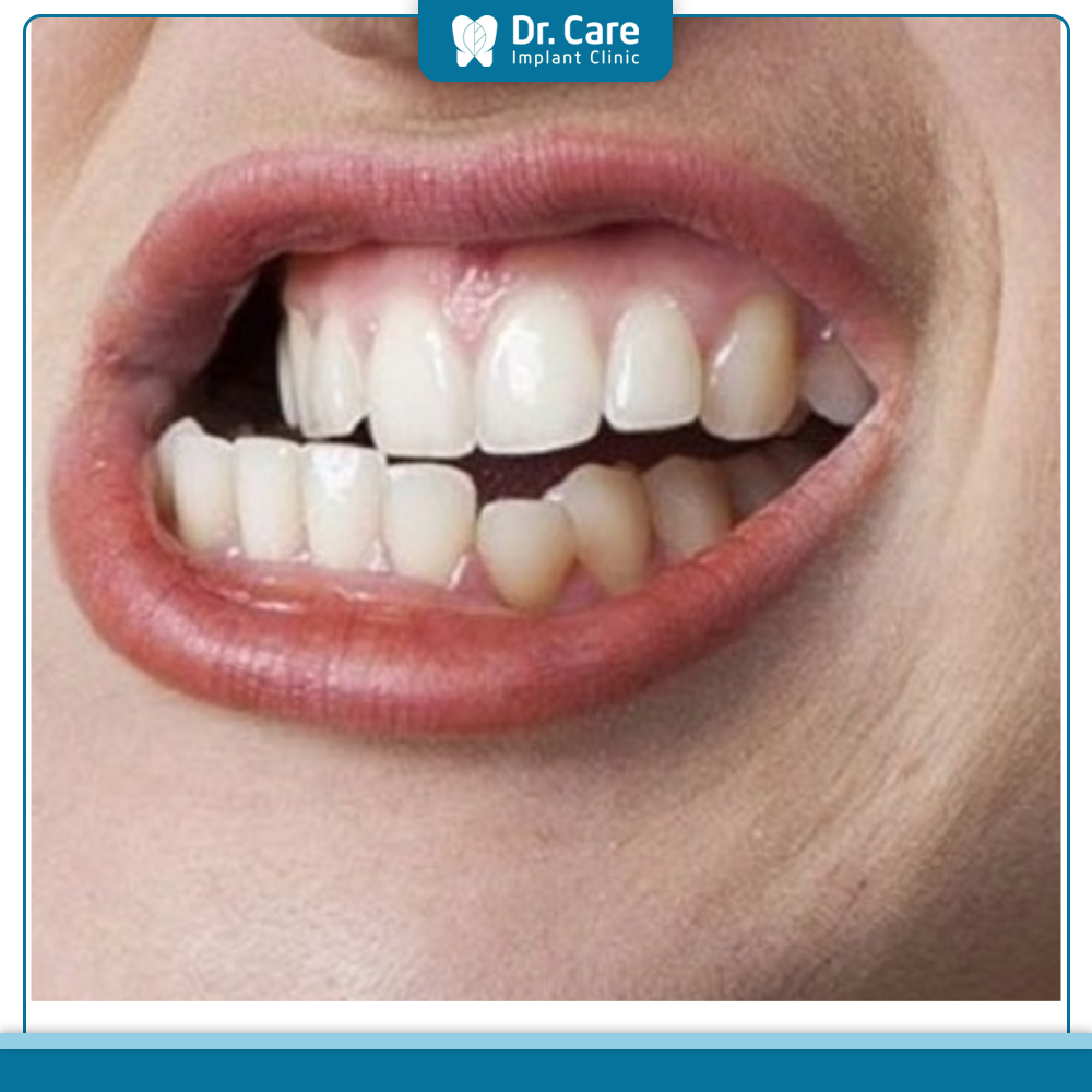 Đau răng sau khi bọc răng sứ có nguy hiểm không?