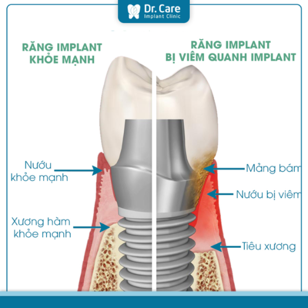 Vấn đề về mô mềm cần phải lưu ý trước khi thực hiện trồng răng Implant