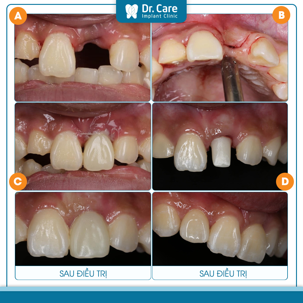 Sau khi mô mềm lành thương bao lâu mới làm phục hình răng trên Implant?