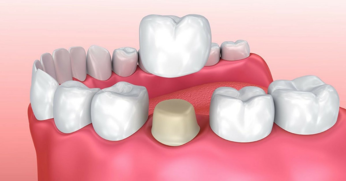 Bọc răng sứ gồm công đoạn bao phủ lên phần răng thật một lớp vỏ sứ
