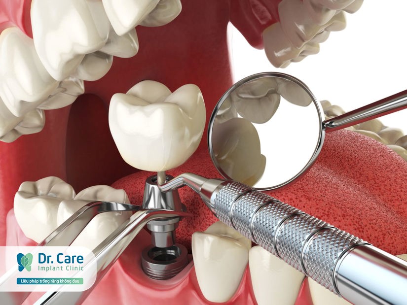 trồng răng Implant dr. care 