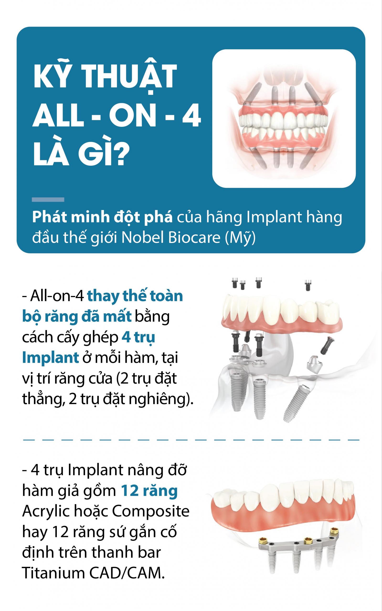 Trồng răng Implant toàn hàm All on 4 là gì?