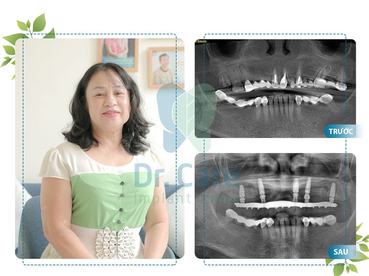 Nha khoa chuyên sâu, uy tín trồng răng Implant