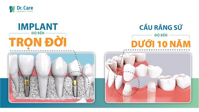 tuổi thọ của răng implant và cầu răng sứ